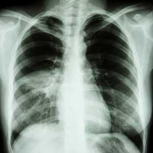Radiografía pulmón